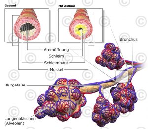 Illustration bronchi and alveoli - MedicalGraphics