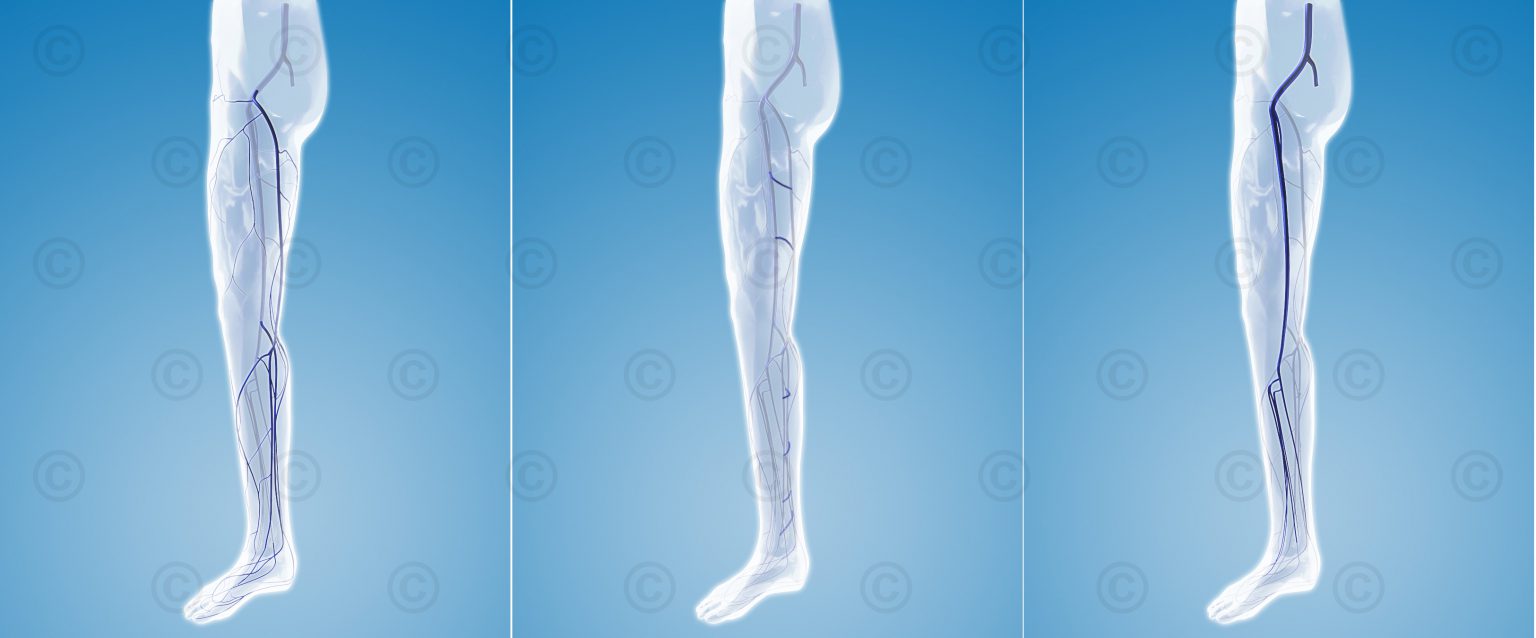 Animation leg veins - MedicalGraphics