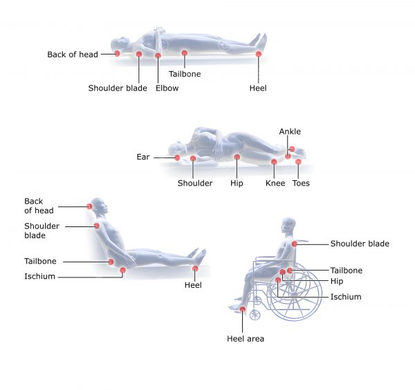 Illustration avoiding of bedsore - MedicalGraphics