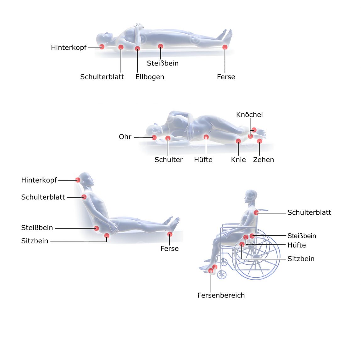 Illustration Lagerung zur Vermeidung von Dekubitus MedicalGraphics