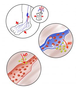 Infografik Zu Kompression-Therapie Bei Gefäßerkrankungen - MedicalGraphics