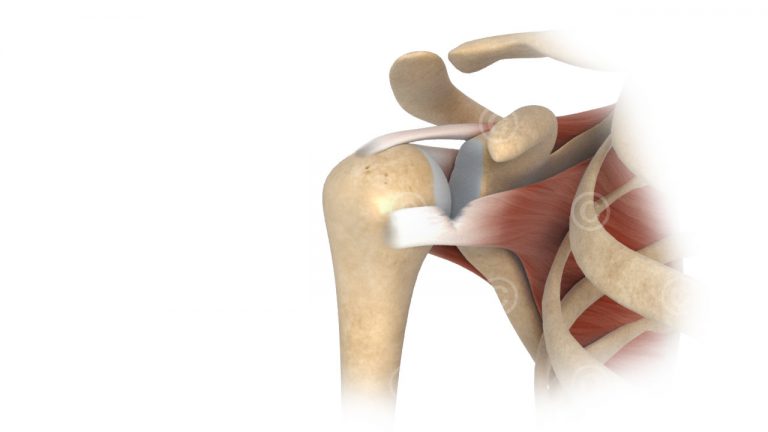 Illustrationen Verletzungen Schulter - MedicalGraphics