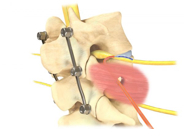 Illustrations DRG stimulation - MedicalGraphics