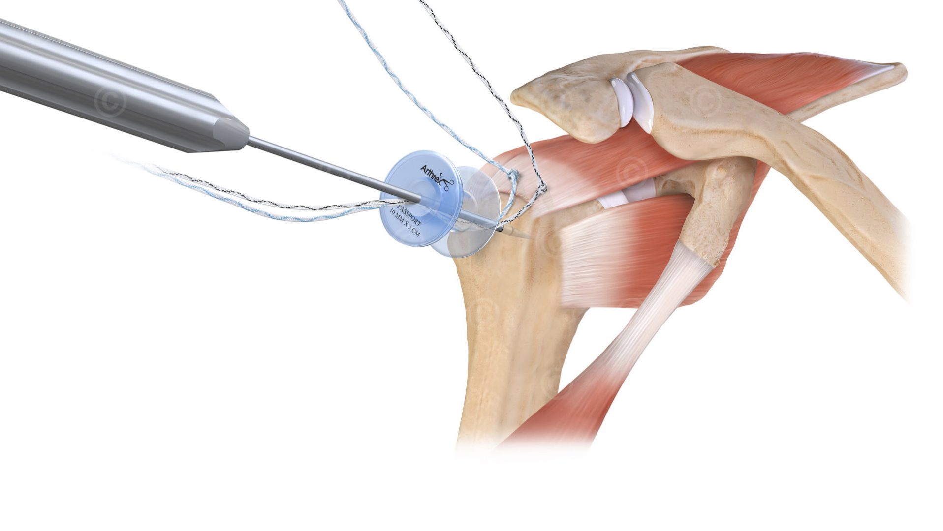 Illustrations surgical instructions rotator cuff - MedicalGraphics