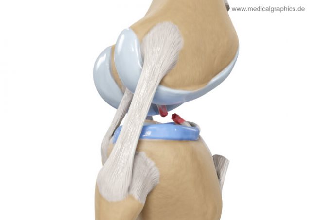 Anterior cruciate ligament tear - lateral - MedicalGraphics