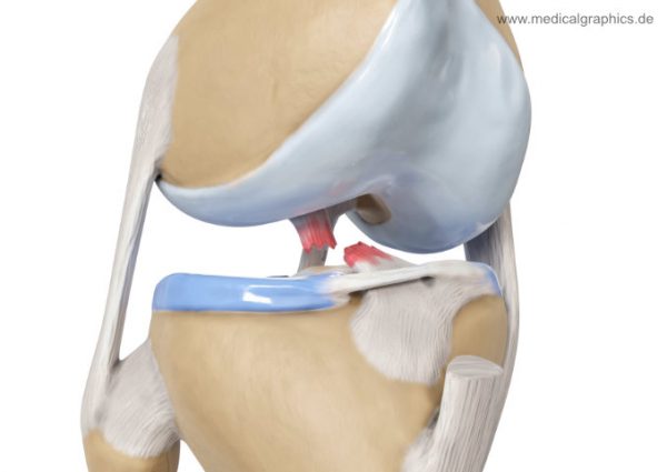 Anterior cruciate ligament tear - lateral front - MedicalGraphics