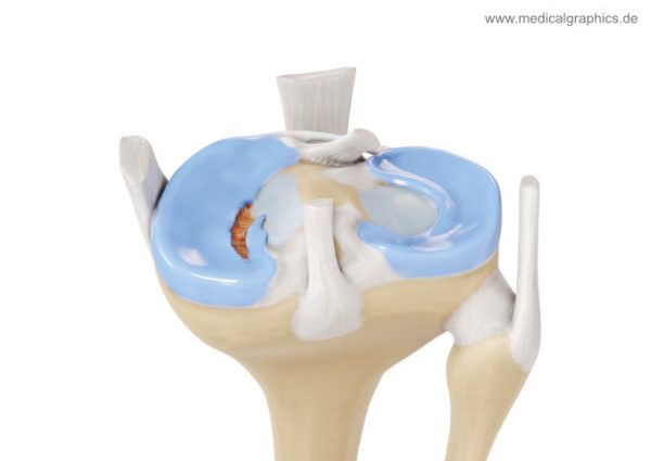 Flap tear meniscus - rear - MedicalGraphics