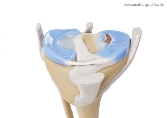 Flap tear meniscus - front - MedicalGraphics