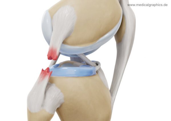 Lateral collateral ligament tear - lateral - MedicalGraphics