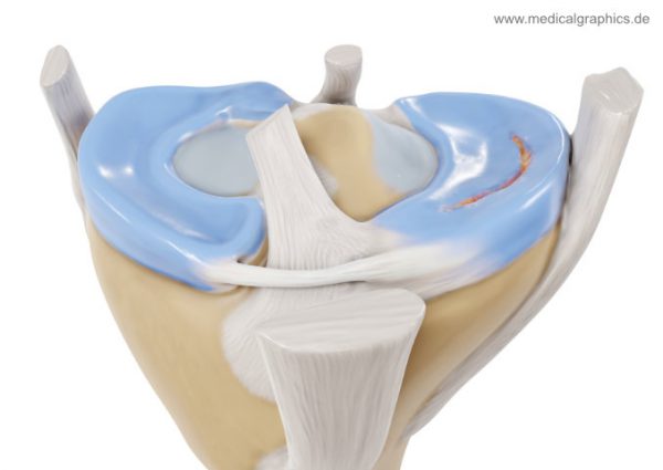 Longitudinal tear meniscus - front - MedicalGraphics