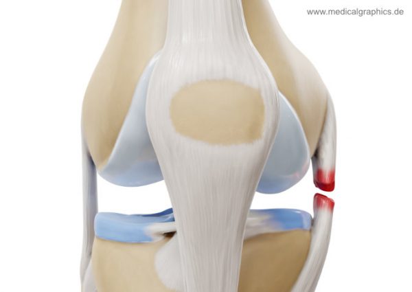 Medial Collateral Ligament Tear - Closeup Front - Medicalgraphics