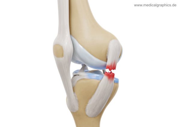 Medial collateral ligament tear - medial - MedicalGraphics